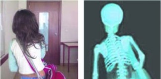 A saúde às costas notícias das Caldas