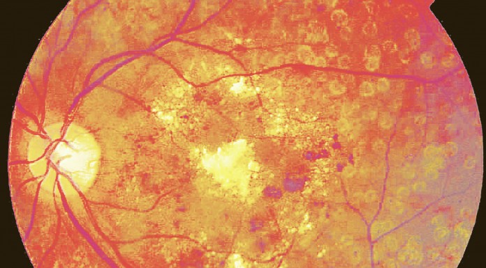 Diabetes – A Epidemia Global do Século XXI Caldas da Rainha