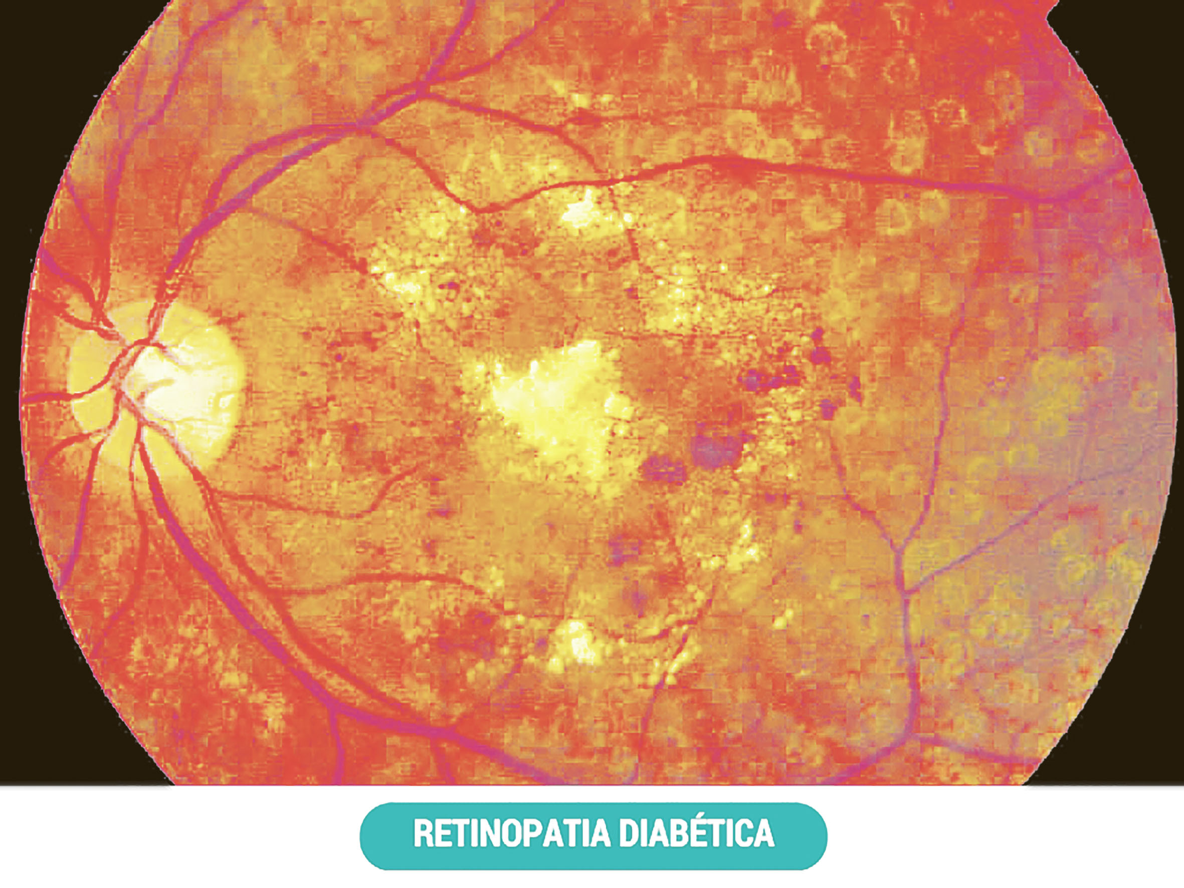 Diabetes  –  A Epidemia Global do Século XXI