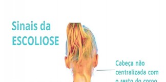 Escoliose, patologia silenciosa Gazeta das Caldas