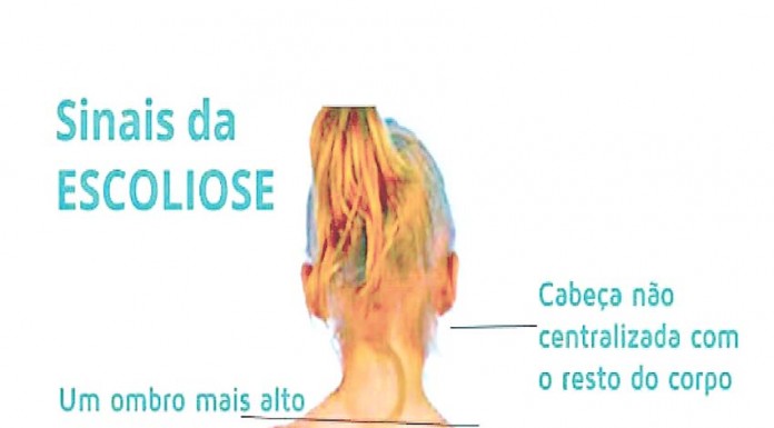 Escoliose, patologia silenciosa Gazeta das Caldas