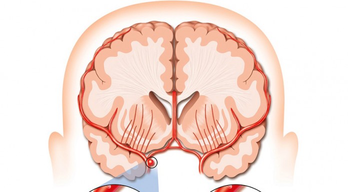 Aumentar o acesso a terapêuticas específicas reduz mortes por AVC Gazeta das Caldas