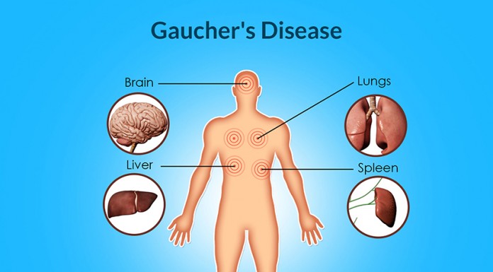 Doença de Gaucher, uma patologia desconhecida por muitos Gazeta das Caldas