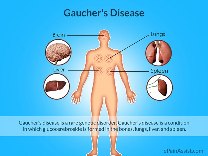 Doença de Gaucher Gazeta das Caldas