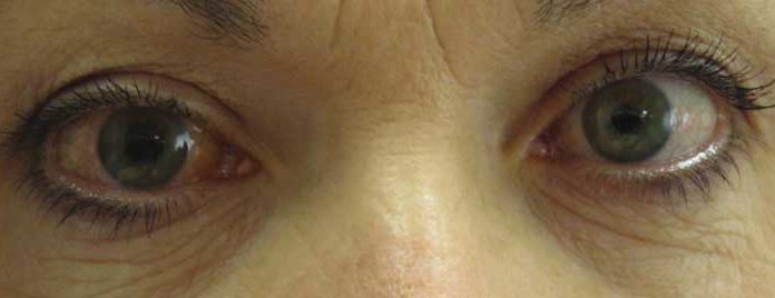 Diagnóstico precoce, a única fórmula para travar o roubo da visão provocado pelo glaucoma gazeta das caldas