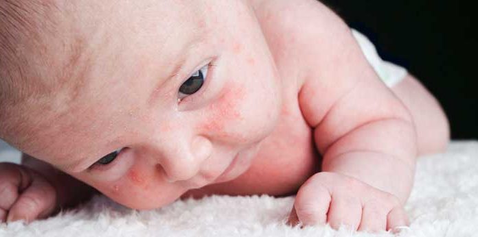 Saúde em Ponto Pequeno – Pele Atópica