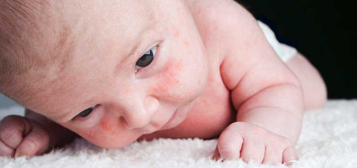 Saúde em Ponto Pequeno – Pele Atópica